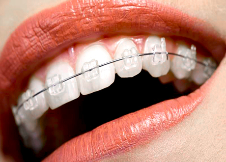 Ceramic Dental Braces