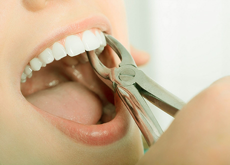 Dental Extraction