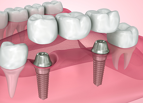 Self Ligating Dental Braces