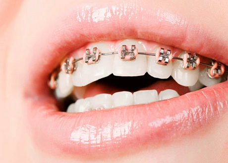 Metal Dental Braces