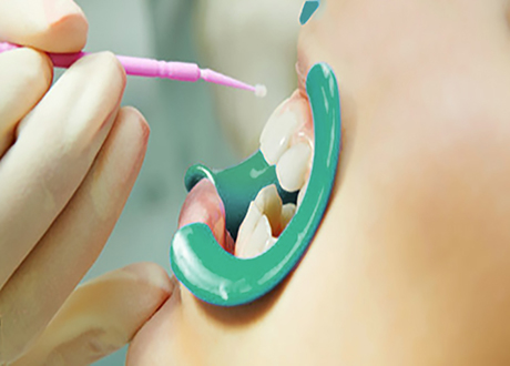 Dental Sealant Treatment