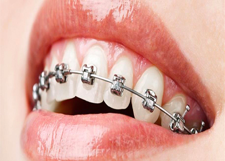 Self Ligating Dental Braces